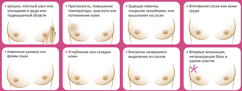 Симптомы рака молочной железы